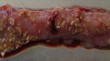 Necrotic Enteritis